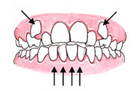 Crowded or Overlaped Teeth