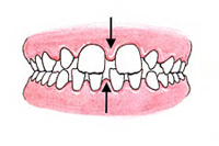 Large Gaps Between Teeth